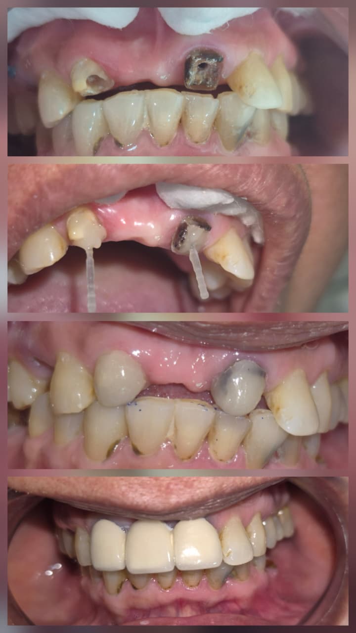 Before and after smile transformation 8